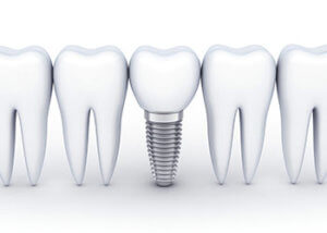 dental implants in doncaster
